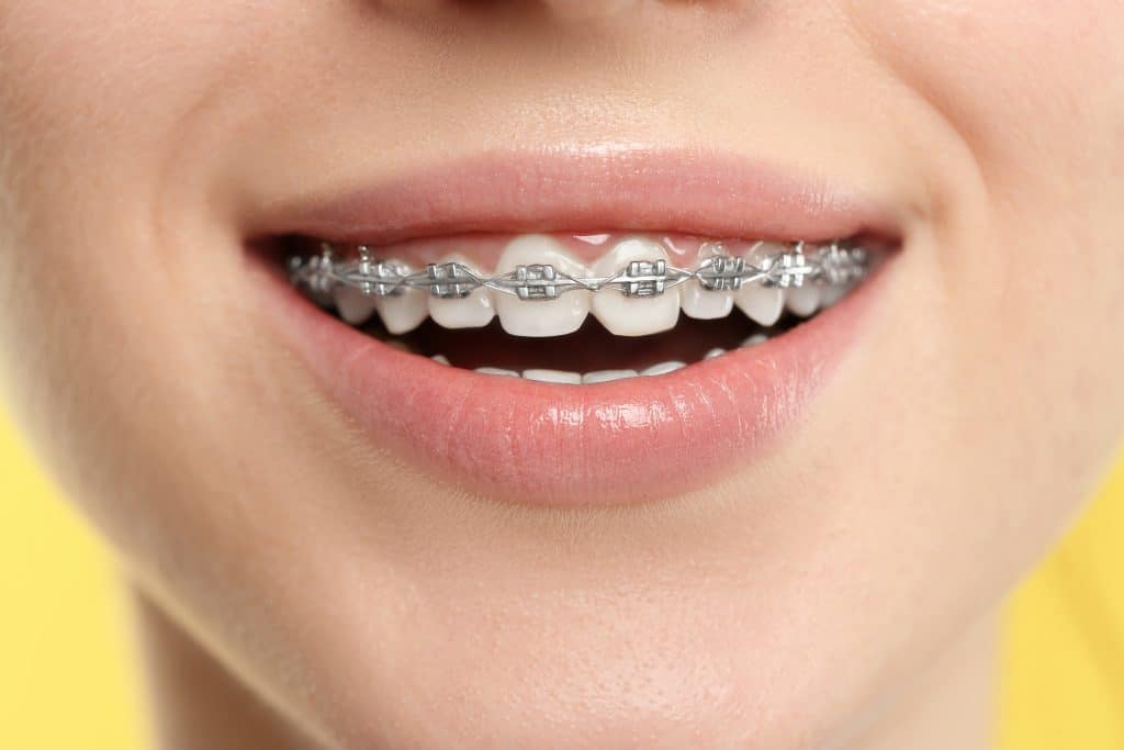 Braces Dorchester